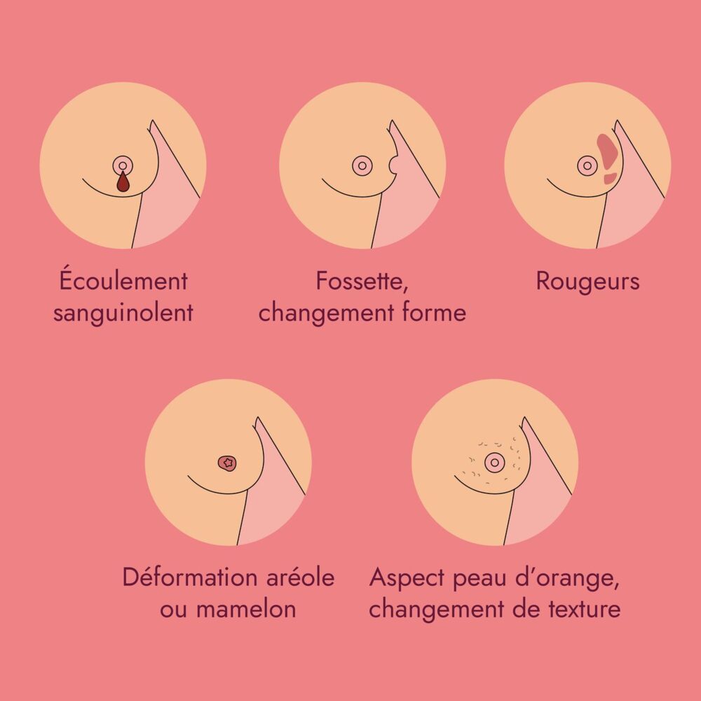 Illustration des signes à surveiller : écoulement sanguinolent, fossette ou changement de forme, rougeurs, déformation de l'aréole ou du mamelon, aspect peau d'orange ou changement de texture
