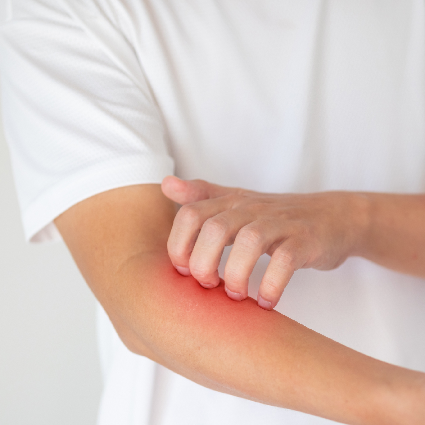 Comprendre l'eczéma atopique (dermatite atopique)